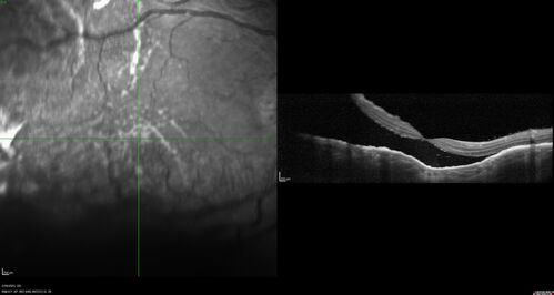 Choroidal Metastatic Breast Cancer with Exudative Detachment
58 year old female presented with 20/200 vision.  Had 10 sessions of radiation and tumor shrank.  The exudative detachment took almost a year to resolve.  The vision improved to 20/40.
