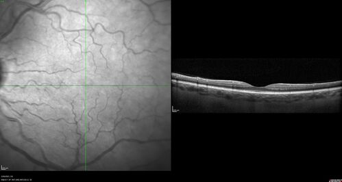 Choroidal Metastatic Breast Cancer with Exudative Detachment
58 year old female presented with 20/200 vision.  Had 10 sessions of radiation and tumor shrank.  The exudative detachment took almost a year to resolve.  The vision improved to 20/40.
