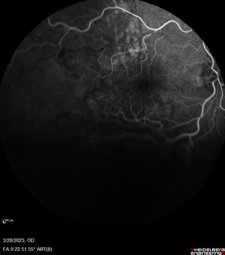Choroidal Metastatic Breast Cancer with Exudative Detachment
58 year old female presented with 20/200 vision.  Had 10 sessions of radiation and tumor shrank.  The exudative detachment took almost a year to resolve.  The vision improved to 20/40.
