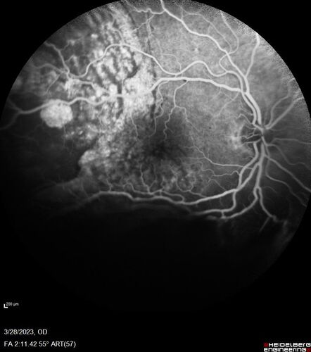 Choroidal Metastatic Breast Cancer with Exudative Detachment
58 year old female presented with 20/200 vision.  Had 10 sessions of radiation and tumor shrank.  The exudative detachment took almost a year to resolve.  The vision improved to 20/40.
