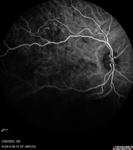 Choroidal Metastatic Breast Cancer with Exudative Detachment
58 year old female presented with 20/200 vision.  Had 10 sessions of radiation and tumor shrank.  The exudative detachment took almost a year to resolve.  The vision improved to 20/40.
