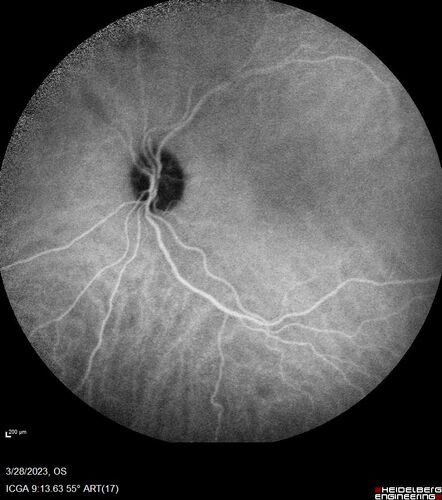 Choroidal Metastatic Breast Cancer with Exudative Detachment
58 year old female presented with 20/200 vision.  Had 10 sessions of radiation and tumor shrank.  The exudative detachment took almost a year to resolve.  The vision improved to 20/40.
