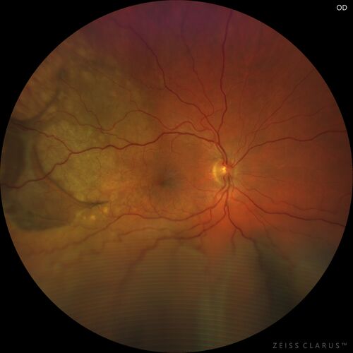 Choroidal Metastatic Breast Cancer with Exudative Detachment
58 year old female presented with 20/200 vision.  Had 10 sessions of radiation and tumor shrank.  The exudative detachment took almost a year to resolve.  The vision improved to 20/40.
