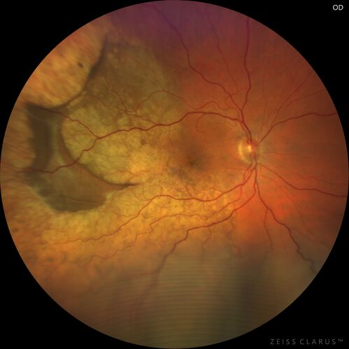 Choroidal Metastatic Breast Cancer with Exudative Detachment
58 year old female presented with 20/200 vision.  Had 10 sessions of radiation and tumor shrank.  The exudative detachment took almost a year to resolve.  The vision improved to 20/40.
