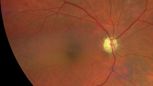 Methanol Toxic Optic Neuropathy
51 year old female lost vision 2 years ago in Indonesia presumably from bad Vodka.  She was treated with 1 gram per day steroids.  Her vision remains NLP in both eyes.  She also suffers from peripheral neuropathy and parkinson's like symptoms.

