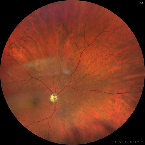 Methanol Toxic Optic Neuropathy
51 year old female lost vision 2 years ago in Indonesia presumably from bad Vodka.  She was treated with 1 gram per day steroids.  Her vision remains NLP in both eyes.  She also suffers from peripheral neuropathy and parkinson's like symptoms.
