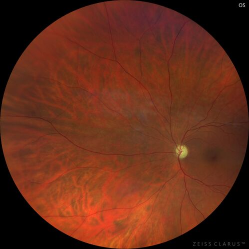 Methanol Toxic Optic Neuropathy
51 year old female lost vision 2 years ago in Indonesia presumably from bad Vodka.  She was treated with 1 gram per day steroids.  Her vision remains NLP in both eyes.  She also suffers from peripheral neuropathy and parkinson's like symptoms.
