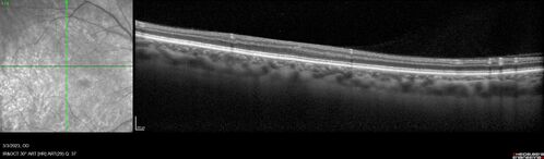 Methanol Toxic Optic Neuropathy
51 year old female lost vision 2 years ago in Indonesia presumably from bad Vodka.  She was treated with 1 gram per day steroids.  Her vision remains NLP in both eyes.  She also suffers from peripheral neuropathy and parkinson's like symptoms.
