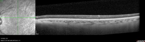 Methanol Toxic Optic Neuropathy
51 year old female lost vision 2 years ago in Indonesia presumably from bad Vodka.  She was treated with 1 gram per day steroids.  Her vision remains NLP in both eyes.  She also suffers from peripheral neuropathy and parkinson's like symptoms.
