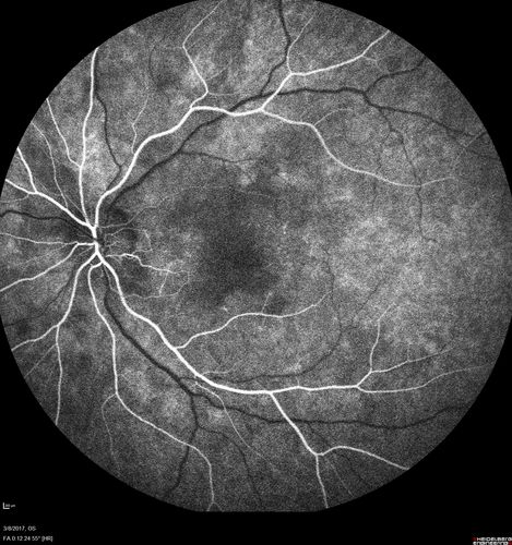 Recurrent MEWDS Left Eye - Teenage Girl
Patient presented in 2014 (first images) 2 months following vision loss left eye.  Vision went from 20/60 - 20/20.  OCT showed outer retinal irregularities which normalized.  Then 3 years later in 2017 she had full blown MEWDS.  She presented acutely and all the images are typical.  Both episodes where in the same time of year, about 3 months after her flu shot for sports.
