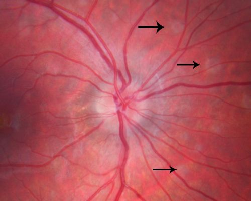 Multiple Evanescent White Dot Syndrome - Atypical Yellow Foveal Spot Right Eye
12-year-old had decreased vision in the left eye from reported amblyopia since around the year 2000.  His right eye was doing fine until  two days ago, when he had sudden severe vision loss.  He sees a blurred spot in the middle of the vision in the right eye wherever he looks. 
 OD 20/60 with eccentric movement, OS 20/200.   Pinhole 20/70.  IOP:  OD 14, OS 10.
Keywords: mewds;multiple evanescent white dot syndrome;yellow spot