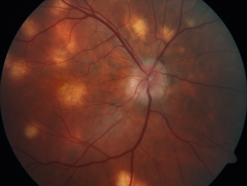 Multifocal Choroiditis - Pneumocystis - aspergillis - cryptococcus
31 year old male with anaplastic astrocytoma on chemotherapy with mild vision loss in the right eye.  LP did not reveal organism.  He was placed on a trial of anti-fungal medications and lost to follow-up
