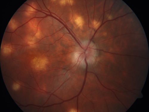Multifocal Choroiditis - Pneumocystis - aspergillis - cryptococcus
31 year old male with anaplastic astrocytoma on chemotherapy with mild vision loss in the right eye.  LP did not reveal organism.  He was placed on a trial of anti-fungal medications and lost to follow-up
