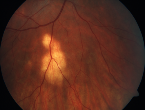 Multifocal Choroiditis - Pneumocystis - aspergillis - cryptococcus
31 year old male with anaplastic astrocytoma on chemotherapy with mild vision loss in the right eye.  LP did not reveal organism.  He was placed on a trial of anti-fungal medications and lost to follow-up
