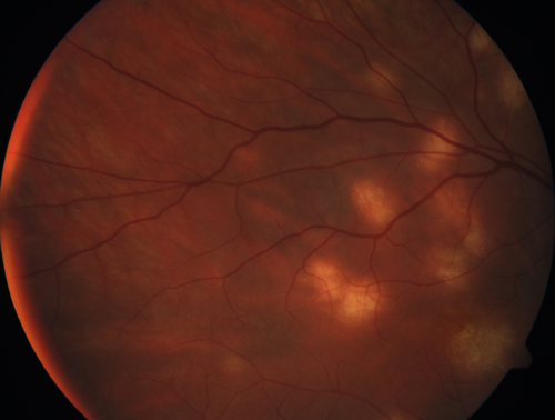 Multifocal Choroiditis - Pneumocystis - aspergillis - cryptococcus
31 year old male with anaplastic astrocytoma on chemotherapy with mild vision loss in the right eye.  LP did not reveal organism.  He was placed on a trial of anti-fungal medications and lost to follow-up
