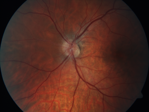 Multifocal Choroiditis - Pneumocystis - aspergillis - cryptococcus
31 year old male with anaplastic astrocytoma on chemotherapy with mild vision loss in the right eye.  LP did not reveal organism.  He was placed on a trial of anti-fungal medications and lost to follow-up
