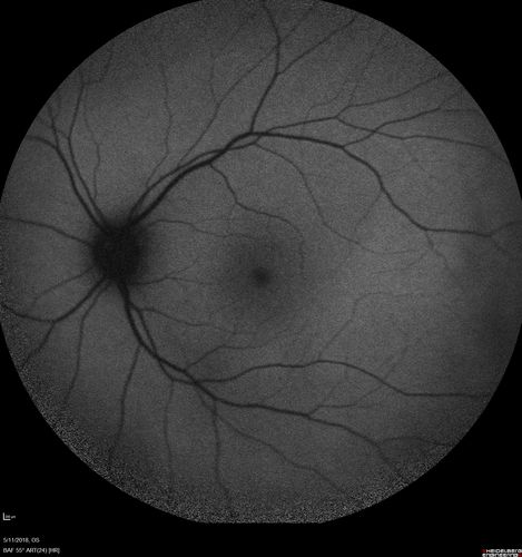 Multifocal Choroiditis - Pneumocystis - aspergillis - cryptococcus
31 year old male with anaplastic astrocytoma on chemotherapy with mild vision loss in the right eye.  LP did not reveal organism.  He was placed on a trial of anti-fungal medications and lost to follow-up
