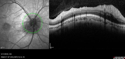 Multifocal Choroiditis - Pneumocystis - aspergillis - cryptococcus
31 year old male with anaplastic astrocytoma on chemotherapy with mild vision loss in the right eye.  LP did not reveal organism.  He was placed on a trial of anti-fungal medications and lost to follow-up
