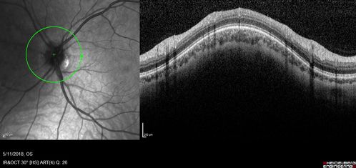 Multifocal Choroiditis - Pneumocystis - aspergillis - cryptococcus
31 year old male with anaplastic astrocytoma on chemotherapy with mild vision loss in the right eye.  LP did not reveal organism.  He was placed on a trial of anti-fungal medications and lost to follow-up
