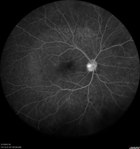 Multifocal Choroiditis - Pneumocystis - aspergillis - cryptococcus
31 year old male with anaplastic astrocytoma on chemotherapy with mild vision loss in the right eye.  LP did not reveal organism.  He was placed on a trial of anti-fungal medications and lost to follow-up
