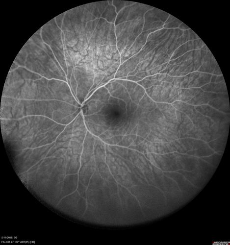 Multifocal Choroiditis - Pneumocystis - aspergillis - cryptococcus
31 year old male with anaplastic astrocytoma on chemotherapy with mild vision loss in the right eye.  LP did not reveal organism.  He was placed on a trial of anti-fungal medications and lost to follow-up
