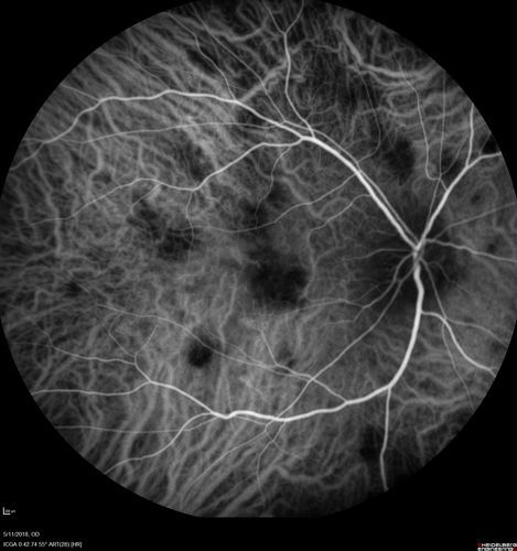 Multifocal Choroiditis - Pneumocystis - aspergillis - cryptococcus
31 year old male with anaplastic astrocytoma on chemotherapy with mild vision loss in the right eye.  LP did not reveal organism.  He was placed on a trial of anti-fungal medications and lost to follow-up
