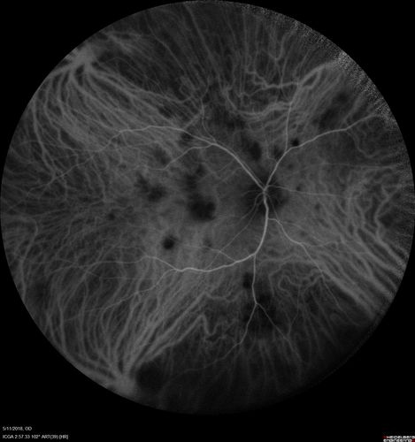Multifocal Choroiditis - Pneumocystis - aspergillis - cryptococcus
31 year old male with anaplastic astrocytoma on chemotherapy with mild vision loss in the right eye.  LP did not reveal organism.  He was placed on a trial of anti-fungal medications and lost to follow-up
