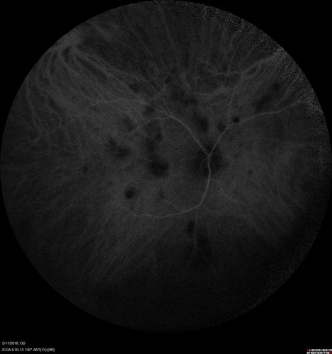 Multifocal Choroiditis - Pneumocystis - aspergillis - cryptococcus
31 year old male with anaplastic astrocytoma on chemotherapy with mild vision loss in the right eye.  LP did not reveal organism.  He was placed on a trial of anti-fungal medications and lost to follow-up
