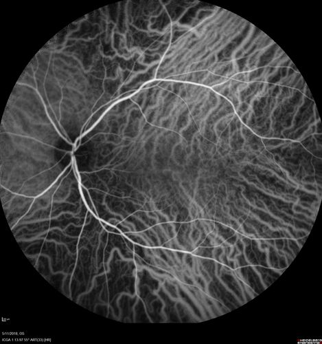 Multifocal Choroiditis - Pneumocystis - aspergillis - cryptococcus
31 year old male with anaplastic astrocytoma on chemotherapy with mild vision loss in the right eye.  LP did not reveal organism.  He was placed on a trial of anti-fungal medications and lost to follow-up
