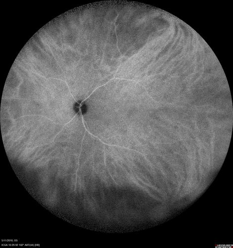 Multifocal Choroiditis - Pneumocystis - aspergillis - cryptococcus
31 year old male with anaplastic astrocytoma on chemotherapy with mild vision loss in the right eye.  LP did not reveal organism.  He was placed on a trial of anti-fungal medications and lost to follow-up
