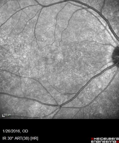 Multifocal Choroiditis Panuveitis with Subretinal Fibrosis Acute Phase
36 year old latin american female 3 weeks of vision loss and new headaches.  MRI was normal.  VA initially 20/32 OD; 20/20 OS Final vision was 20/63 OD; 20/20 OS
