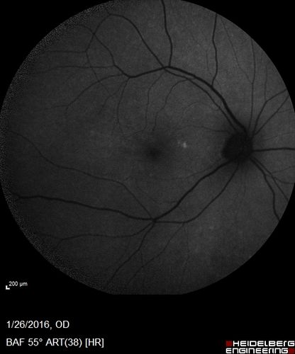 Multifocal Choroiditis Panuveitis with Subretinal Fibrosis Acute Phase
36 year old latin american female 3 weeks of vision loss and new headaches.  MRI was normal.  VA initially 20/32 OD; 20/20 OS Final vision was 20/63 OD; 20/20 OS
