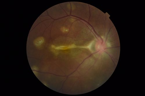 Multifocal Choroiditis Panuveitis with Subretinal Fibrosis Acute Phase
36 year old latin american female 3 weeks of vision loss and new headaches.  MRI was normal.  VA initially 20/32 OD; 20/20 OS Final vision was 20/63 OD; 20/20 OS
