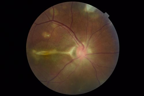 Multifocal Choroiditis Panuveitis with Subretinal Fibrosis Acute Phase
36 year old latin american female 3 weeks of vision loss and new headaches.  MRI was normal.  VA initially 20/32 OD; 20/20 OS Final vision was 20/63 OD; 20/20 OS
