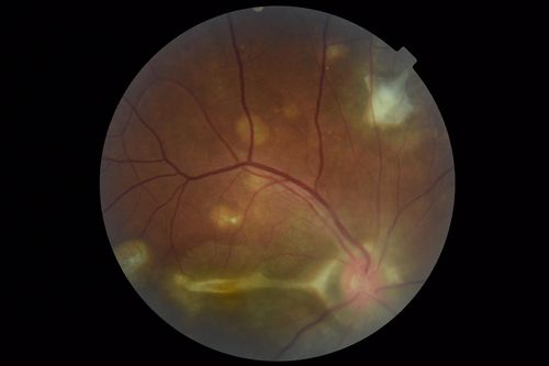Multifocal Choroiditis Panuveitis with Subretinal Fibrosis Acute Phase
36 year old latin american female 3 weeks of vision loss and new headaches.  MRI was normal.  VA initially 20/32 OD; 20/20 OS Final vision was 20/63 OD; 20/20 OS
