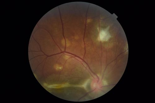 Multifocal Choroiditis Panuveitis with Subretinal Fibrosis Acute Phase
36 year old latin american female 3 weeks of vision loss and new headaches.  MRI was normal.  VA initially 20/32 OD; 20/20 OS Final vision was 20/63 OD; 20/20 OS
