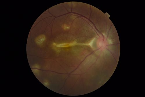 Multifocal Choroiditis Panuveitis with Subretinal Fibrosis Acute Phase
36 year old latin american female 3 weeks of vision loss and new headaches.  MRI was normal.  VA initially 20/32 OD; 20/20 OS Final vision was 20/63 OD; 20/20 OS
