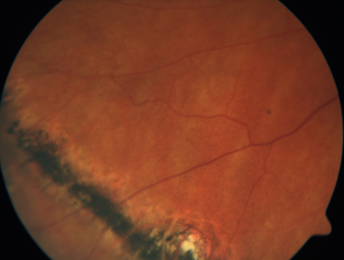 Multifocal Choroiditis - Linear Scars - Schlaegel lines
66 year old woman with macular pucker right eye.  Images show typical linear peripheral scars for MFC or POHS - this is unilateral.
