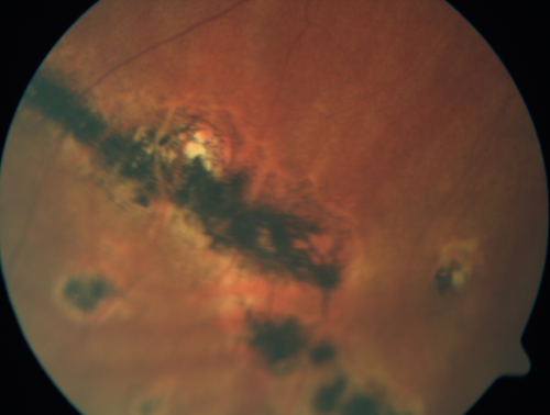 Multifocal Choroiditis - Linear Scars - Schlaegel lines
66 year old woman with macular pucker right eye.  Images show typical linear peripheral scars for MFC or POHS - this is unilateral.

