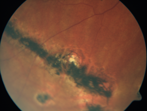 Multifocal Choroiditis - Linear Scars - Schlaegel lines
66 year old woman with macular pucker right eye.  Images show typical linear peripheral scars for MFC or POHS - this is unilateral.
