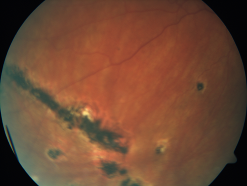 Multifocal Choroiditis - Linear Scars - Schlaegel lines
66 year old woman with macular pucker right eye.  Images show typical linear peripheral scars for MFC or POHS - this is unilateral.
