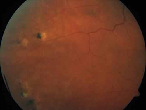 Multifocal Choroiditis - Linear Scars - Schlaegel lines
66 year old woman with macular pucker right eye.  Images show typical linear peripheral scars for MFC or POHS - this is unilateral.
