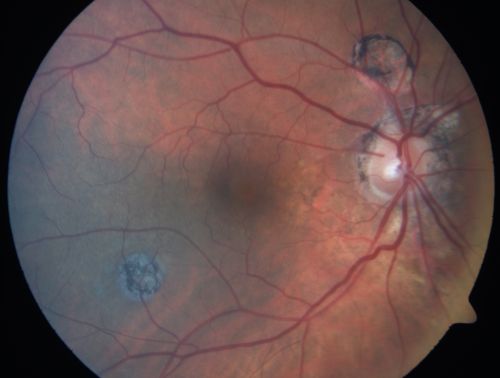 Multifocal Choroiditis Old Scars - Also Peripapillary Scar 82 Year Old Woman
82-year-old woman with multifocal chorioretinal scars, more in the right than the left eye.  OD is 20/40, OS is 20/20.  
