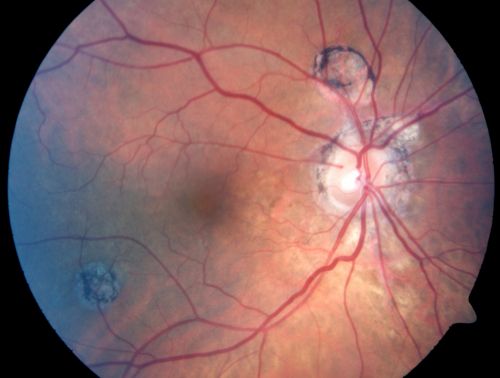 Multifocal Choroiditis Old Scars - Also Peripapillary Scar 82 Year Old Woman
82-year-old woman with multifocal chorioretinal scars, more in the right than the left eye.  OD is 20/40, OS is 20/20.  

