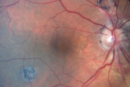 Multifocal Choroiditis Old Scars - Also Peripapillary Scar 82 Year Old Woman
82-year-old woman with multifocal chorioretinal scars, more in the right than the left eye.  OD is 20/40, OS is 20/20.  
