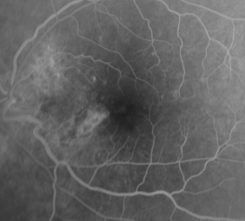 Multifocal Choroiditis and Subretinal Fibrosis - 32 yo Female New Lesion OS
32-year-old woman vision loss in the right eye associated with macular scarring and multifocal choroiditis in 1999 with new vision loss in left eye:  OD 20/400, OS 20/50. 
Keywords: Multifocal Choroiditis; Macular Scar; Fibrosis; Uveitis