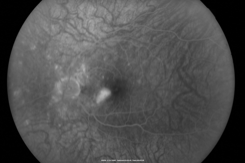 Multifocal Choroiditis and Subretinal Fibrosis - 32 yo Female FA New Lesion OS
32-year-old woman vision loss in the right eye associated with macular scarring and multifocal choroiditis in 1999 with new vision loss in left eye:  OD 20/400, OS 20/50. 
Keywords: Multifocal Choroiditis;Macular Scar;Fibrosis;Uveitis