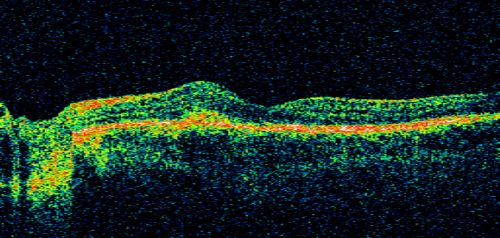 Multifocal Choroiditis and Subretinal Fibrosis - 32 yo Female Line Scan New Lesion OS
32-year-old woman vision loss in the right eye associated with macular scarring and multifocal choroiditis in 1999 with new vision loss in left eye:  OD 20/400, OS 20/50. 
Keywords: Multifocal Choroiditis;Macular Scar;Fibrosis;Uveitis