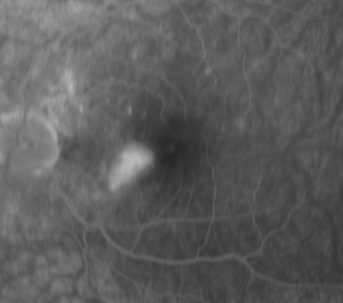 Multifocal Choroiditis and Subretinal Fibrosis - 32 yo Female New Lesion OS
32-year-old woman vision loss in the right eye associated with macular scarring and multifocal choroiditis in 1999 with new vision loss in left eye:  OD 20/400, OS 20/50. 
Võtmesõnad: Multifocal Choroiditis; Macular Scar; Fibrosis; Uveitis