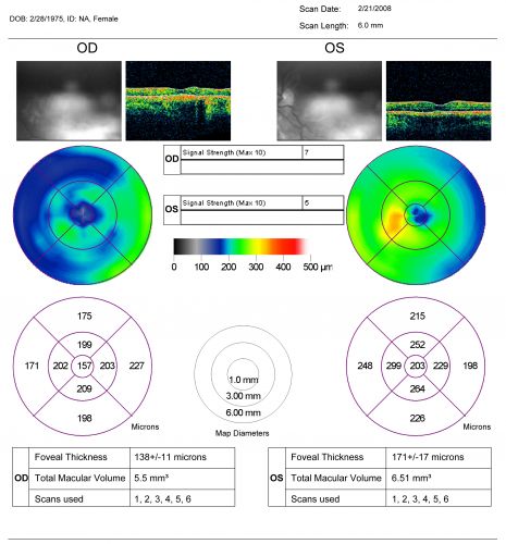 Multifocal Choroiditis and Subretinal Fibrosis - 32 yo Female OCT map
32-year-old woman vision loss in the right eye associated with macular scarring and multifocal choroiditis in 1999 with new vision loss in left eye:  OD 20/400, OS 20/50. 
Keywords: Multifocal Choroiditis;Macular Scar;Fibrosis;Uveitis